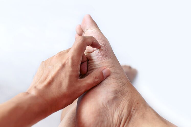 Epidermofitius