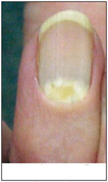proximalis-deformáló gomba